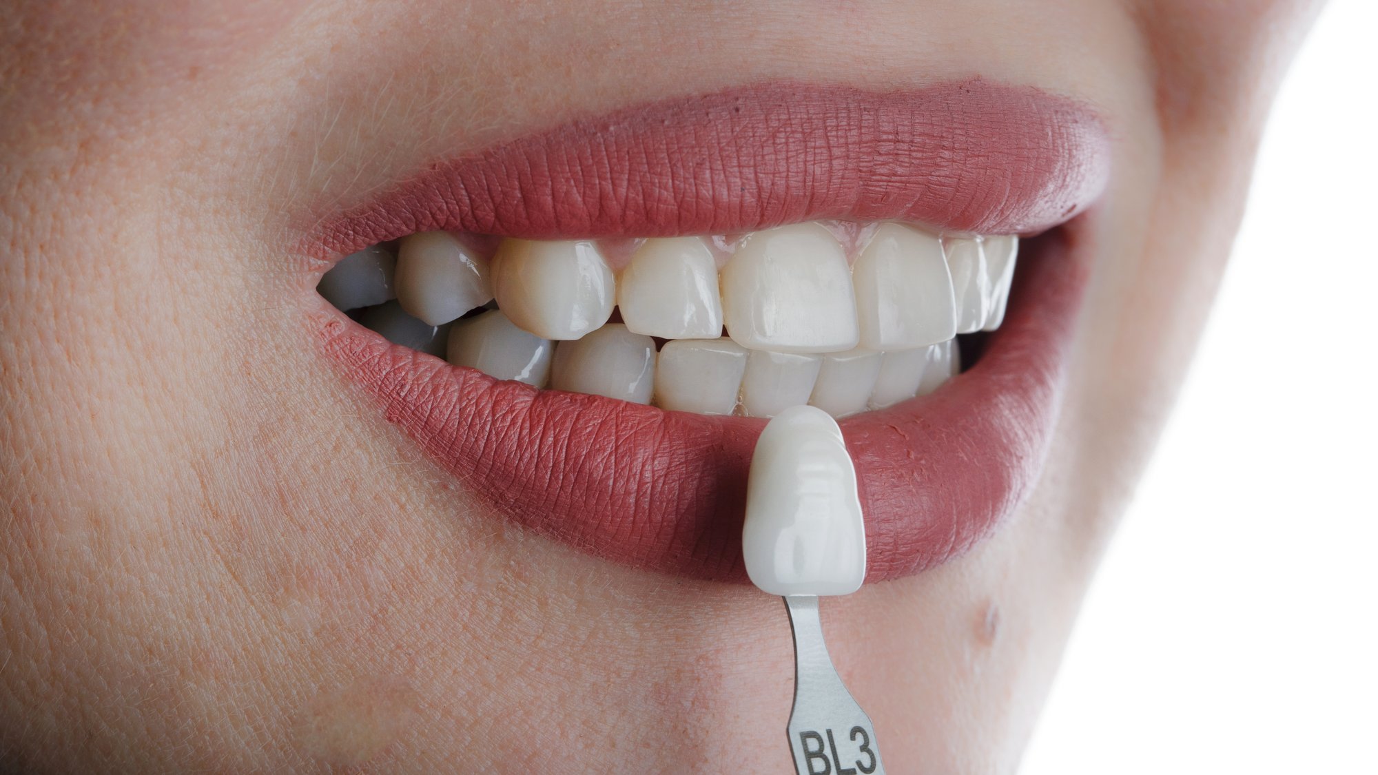 Professional vs. At-Home Teeth Whitening: Which Works?